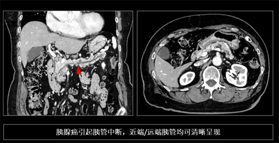 登陆中国，首款16cm光谱成像、超高清宽体CT国产上市(图5)